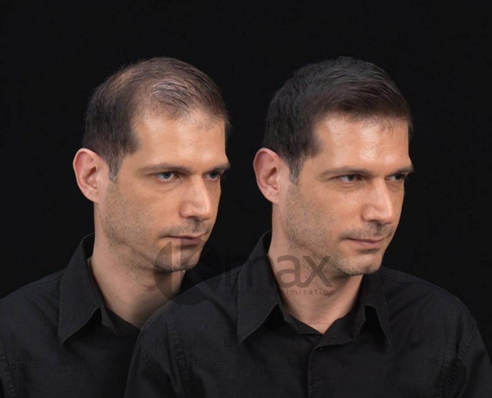 τα καλυτερα αντρικά κουρέματα για αραιά μαλλιά